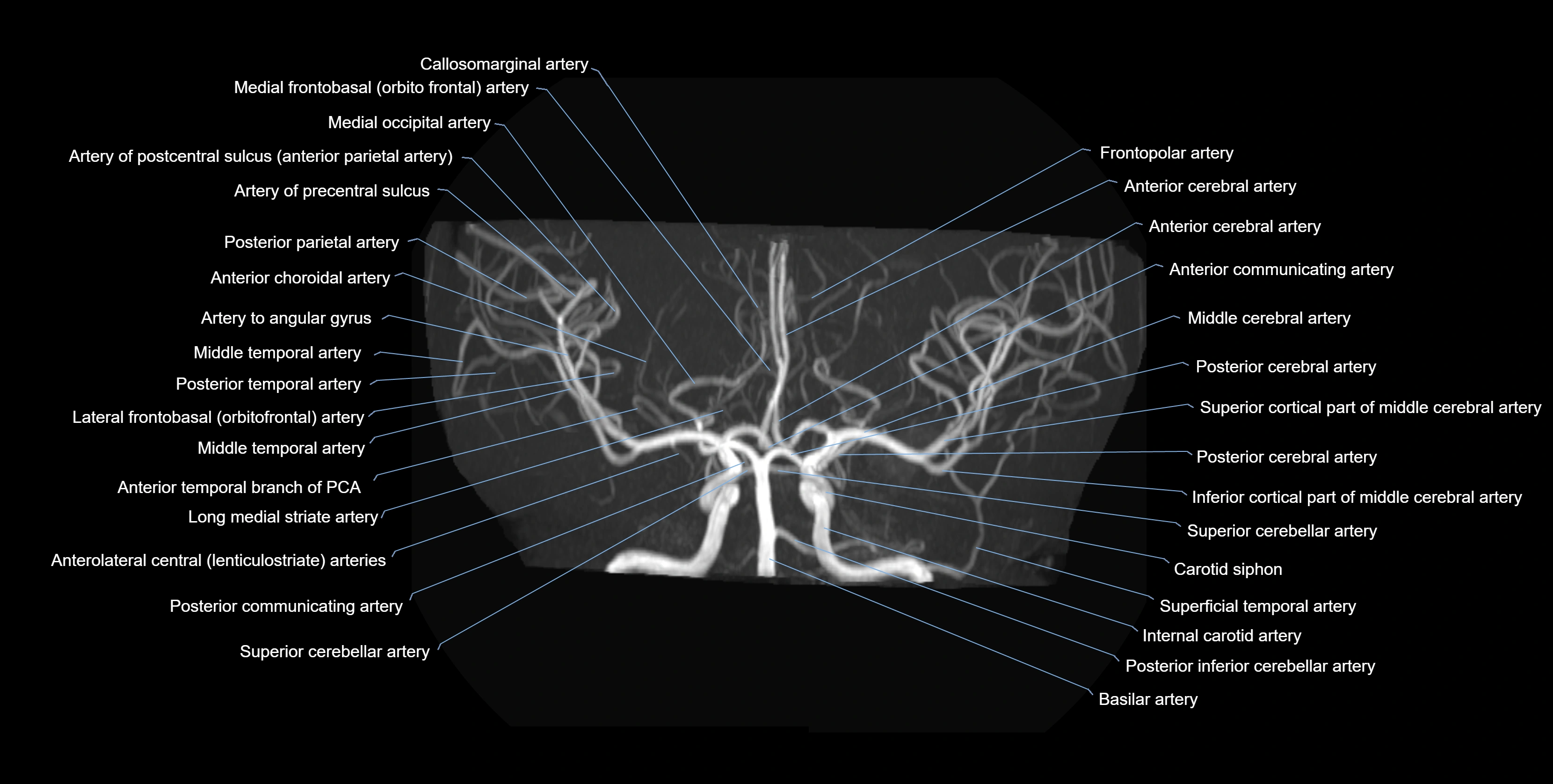 MRA brain axial MIP labelled  anatomy 3T MRI images -img-01021-00009.webp